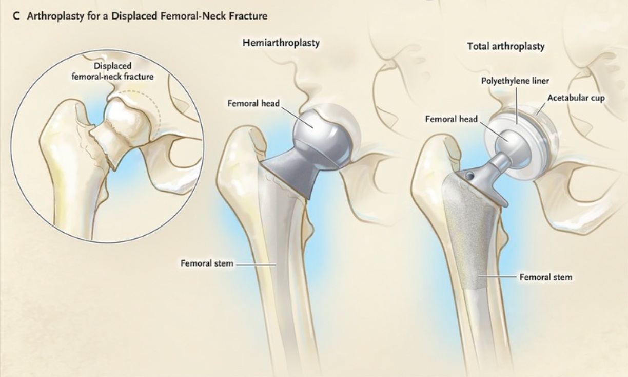 Total Hip Arthroplasty or Hemiarthroplasty for Hip Fracture NEJM