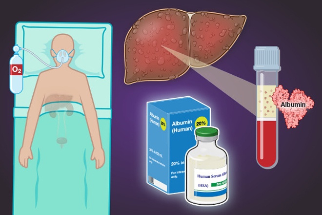 Albumin Infusions in Patients with Cirrhosis | NEJM Resident 360
