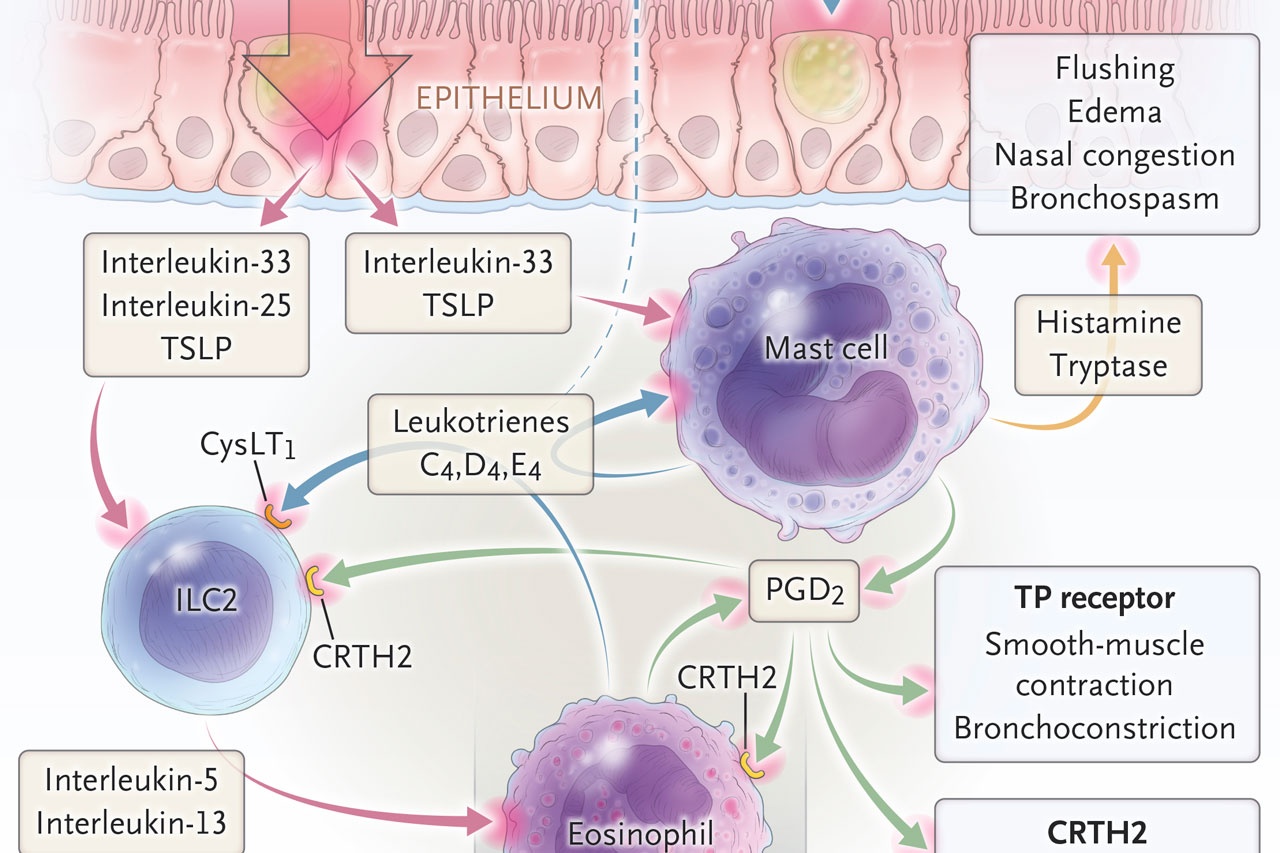 AspirinExacerbated Respiratory Disease NEJM Resident 360